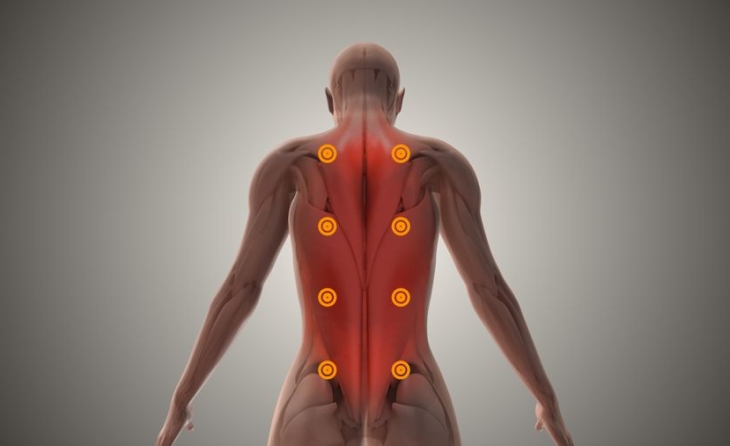 Μυοπεριτονιακό Σύνδρομο